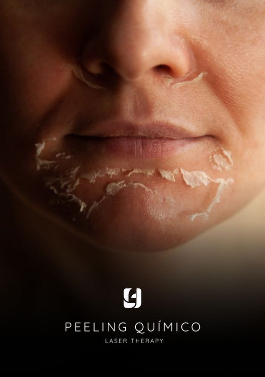 Peeling Químico