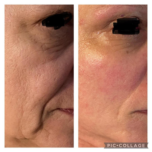 Dermapen Promo Flash