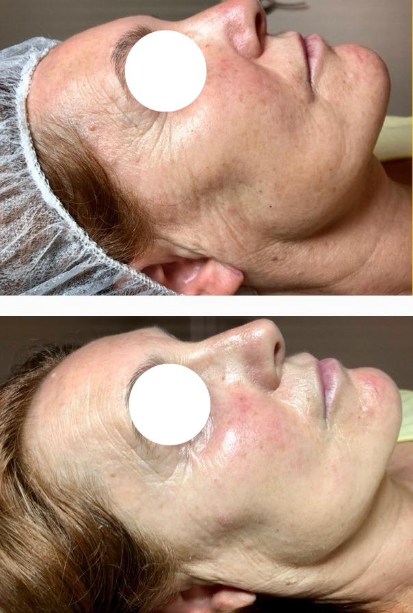Dermapen Promo Flash