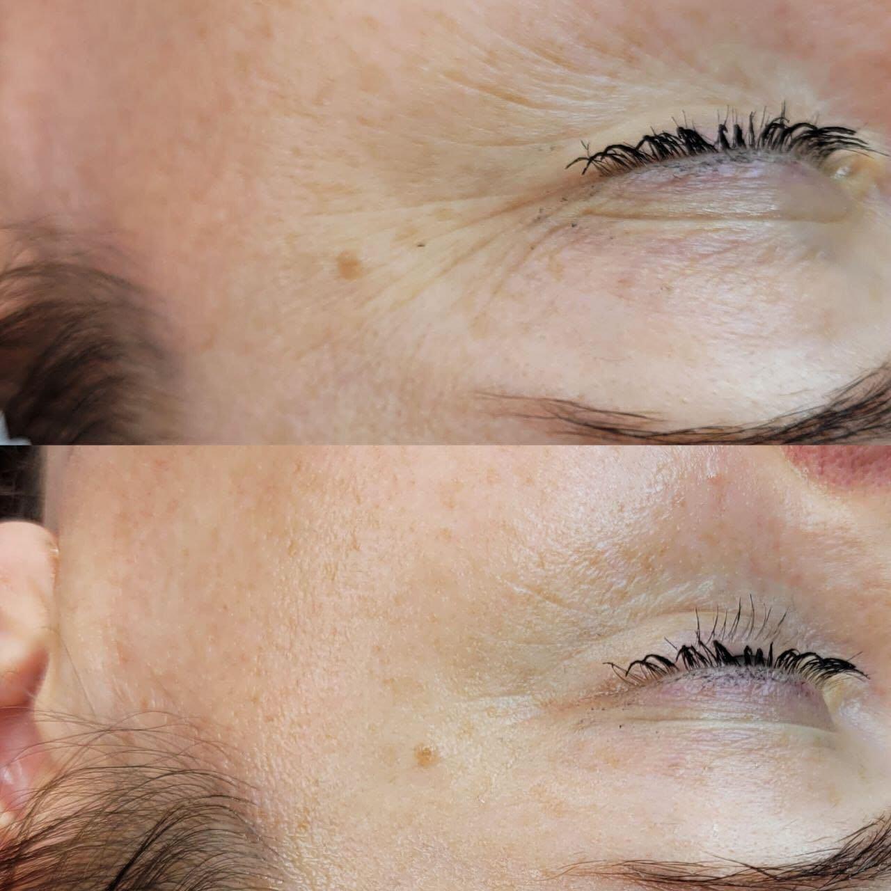 Dermapen Promo Flash