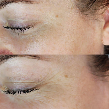 Dermapen Promo Flash