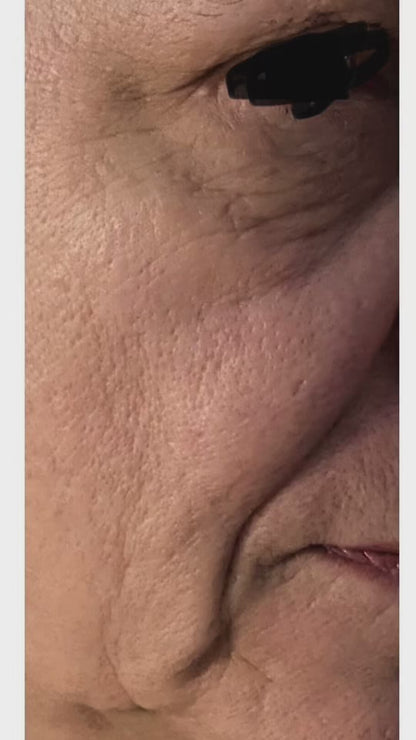 Dermapen Promo Flash